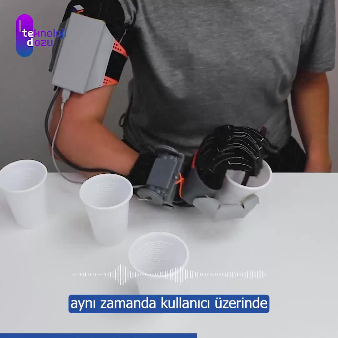 3D Yazıcıyla Geliştirilen Altıncı Parmak Protezi