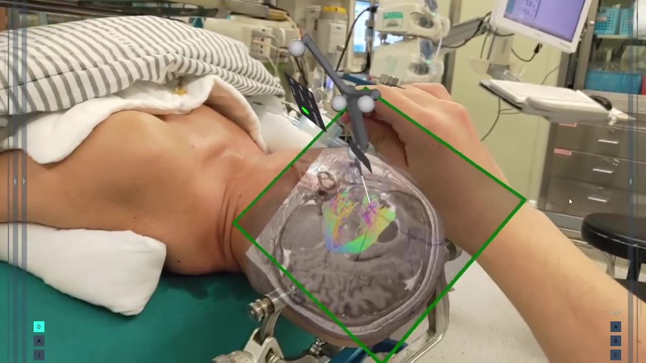 MEDIVIS'in beyin cerrahisi için geliştirdiği AR teknolojisi