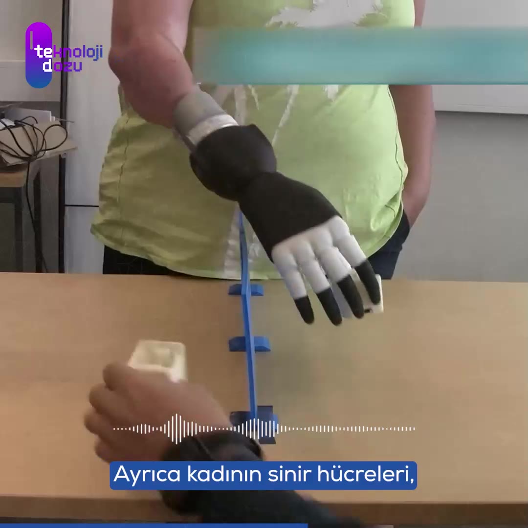 Biyonik el, hastanın hayatını tamamen değiştirdi!